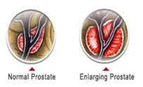 TURP Surgery
